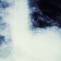 Coping with an Asbestos Cancer Diagnosis