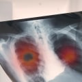 Understanding the Risk of Mesothelioma from Previous Lung Conditions