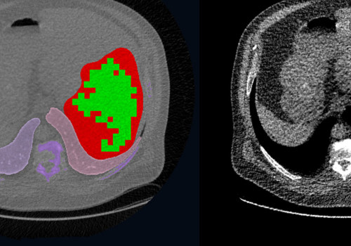 Exploring Computed Tomography (CT) Scans for Mesothelioma Diagnosis