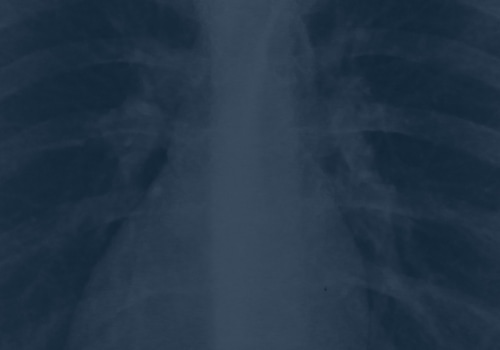 Coping with a Pericardial Mesothelioma Diagnosis