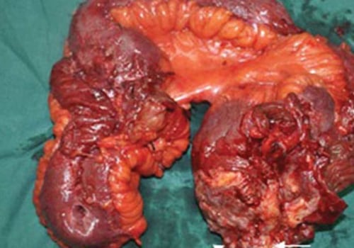 Abdominal Pain and Swelling: Symptoms of Peritoneal Mesothelioma